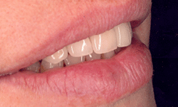 Case Implant Bridge After