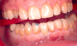 Case Implant Bridge Before