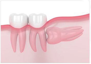 Wisdom Teeth Illustration