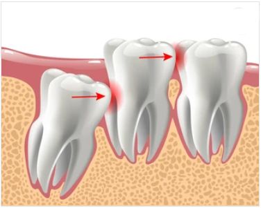 Wisdom Teeth Illustration